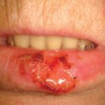 lip-cancer-symptoms