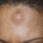 lump-on-forehead