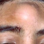 lump-on-forehead-image