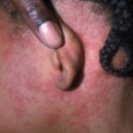 measles-rash-behind-ears