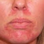 periorificial-dermatitis-on-lips-and-around-mouth