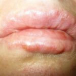 picture-of-bumps-on-lips