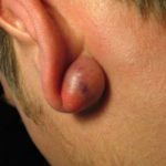 picture-of-cyst-behind-ear