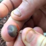 popping-a-blood-blister-on-finger-can-result-to-infection