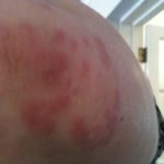 raised-rash-on-elbow