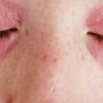 rash-around-eyes-picture