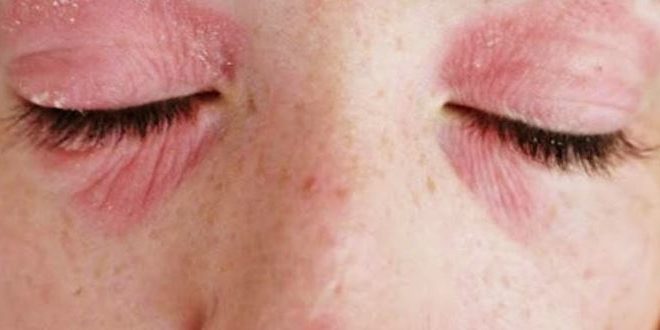 Rash Around Eyes Causes Red Pictures Not Itchy Shingles Lupus 