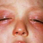 rash-around-eyes-in-child