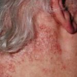 rash-behind-ear-and-neck-picture