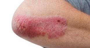 Rash on Elbow Picture