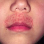 rash-on-upper-lips-image