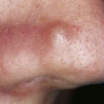 sebaceous-cyst-on-nose-picture