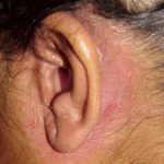 seborrheic-dermatitis-behind-ears