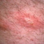 signs-of-herpes-on-scrotum-rash