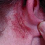 skin-rash-behind-ear