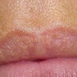 small-bumps-on-lips-fordyce-spots