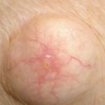 underarm-cyst-picture