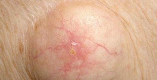 armpit-cyst-causes-painful-symptoms-removal-treatment