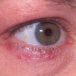 what-causes-rash-in-adult-eye