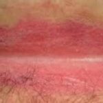 yeast-infection-in-your-armpit-can-cause-itchy-rash