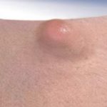 A Cyst on Inner Thigh