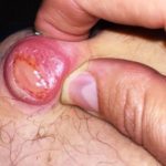 A Sebaceous Thigh Cyst image