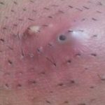 Appearance of an Ingrown Hair