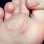 Bump on Bottom of Foot caused by Athlete’s Foot