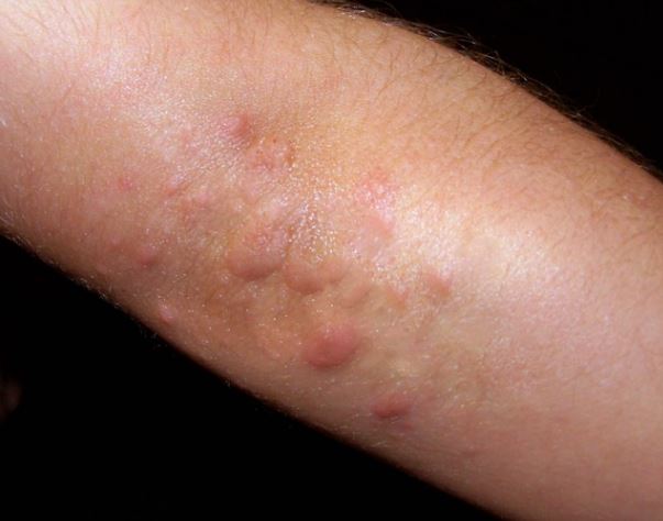 Itchy Elbows Causes Bumps Rash No Rash Non Itchy Symptoms Treat 