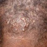 Bumps on Scalp causing Hair Loss