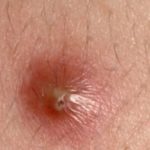 Cyst on Inner Thigh Male