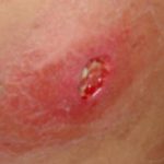 Deep Infected Ingrown Hair photo