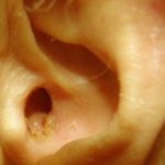 Ear Canal Infection may be the cause of Itching