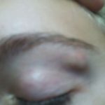 Hard Lump on Eyebrow