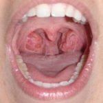 Holes in Tonsils Image