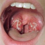 Holes in Tonsils Picture