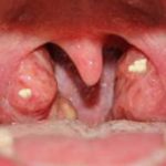 Holes in Tonsils with white Stuff or Chunk