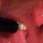 Holes or Crypts in Tonsils that collect food