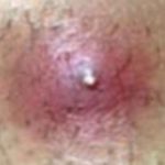 Infected Ingrown Hair Boil image