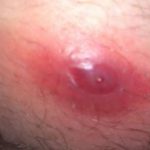 Infected Ingrown Hair Bump