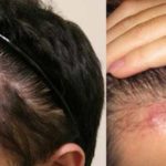 Ingrown Hair on Head Scalp Image