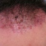 Ingrown Hair on Scalp Picture