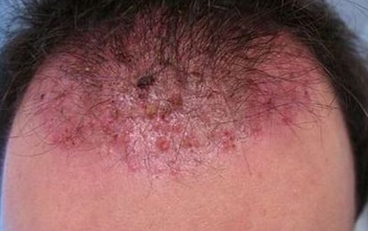 Ingrown Hair on Scalp, Head, Cyst, Pictures, Causes ...