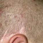 Itchy Bumps on Scalp Pictures