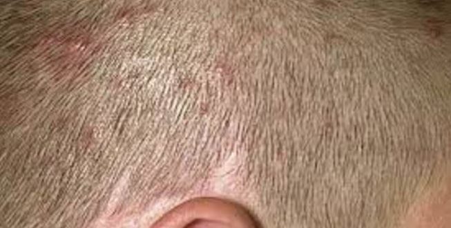 really-red-scalp-dermatology-forums-patient