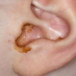 Itchy Ear Canal from Excessive Wax Secretion