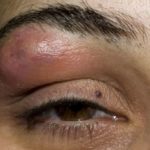 Lump on Eyebrow above Eye