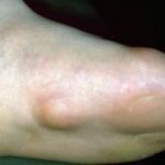 Painful Bumps on Bottom of Foot