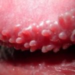 Pearly Penile Papules