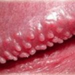 Pearly Penile Papules Picture